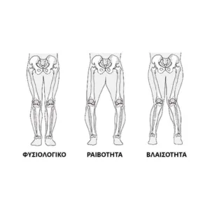 Νάρθηκας Οστεοαρθρίτιδας Γόνατος "SPARTAN"